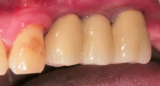 CLINICAL VIDEO Calculating Graft Volume from a Cone Beam CT Scan