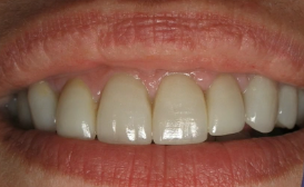 Utilizing Laser Technology in Managing Periodontal Environments to Implants