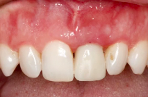 Horizontal Bone Augmentation using the Ridge Expansion Technique