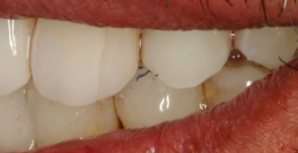CLINICAL VIDEO Single Implant Placement for Missing Upper Premolar: Restorative 