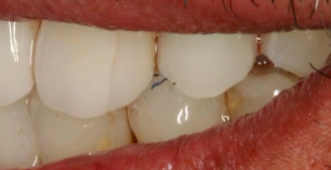 CLINICAL VIDEO Single Implant Placement for Missing Upper Premolar