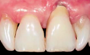 Implant Placement Post-Extraction in Esthetic Single Tooth Sites|Dr Daniel Buser