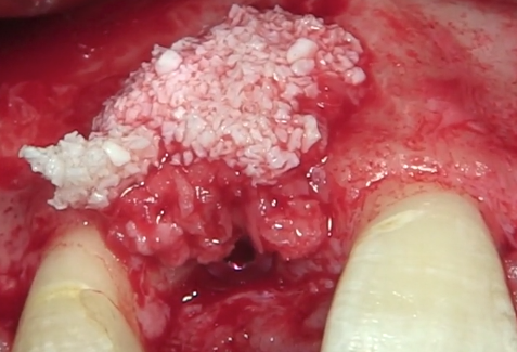 CLINICAL VIDEO Anterior Implant Placement with Simultaneous GBR using Autogenous