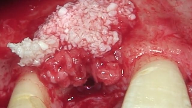 CLINICAL VIDEO Anterior Implant Place...