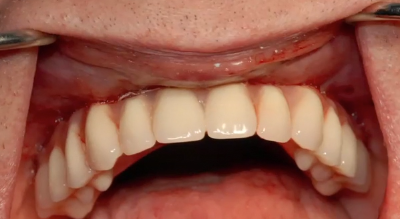 A-Z in Restorative Implant Dentistry (Case 2) - Maxillary Full Arch PFM Bridge