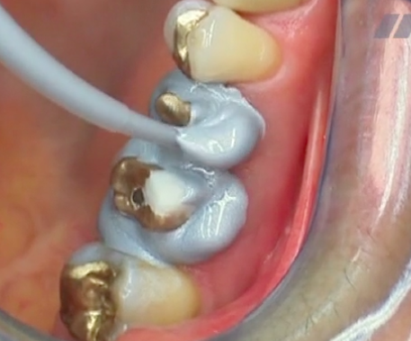 CLINICAL VIDEO Posterior Crown Restorations, Posterior Inlay Restorations & Easy