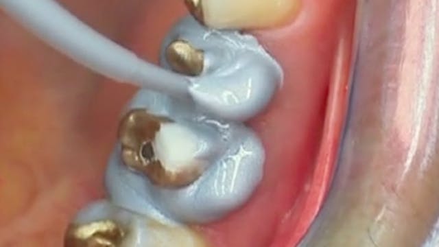 CLINICAL VIDEO Posterior Crown Restor...