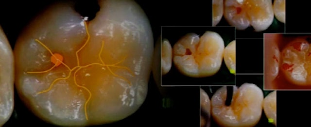 Plastic Restorations in Posterior Teeth
