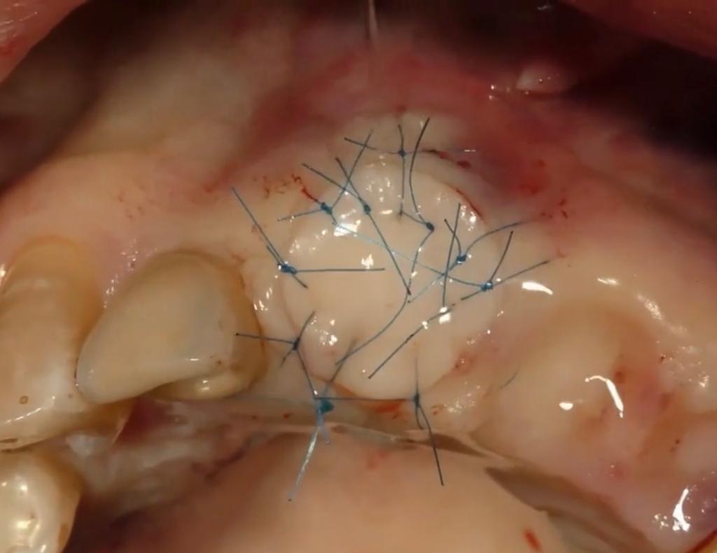 CLINICAL VIDEO Soft tissue seal using a plug graft for extraction socket preserv