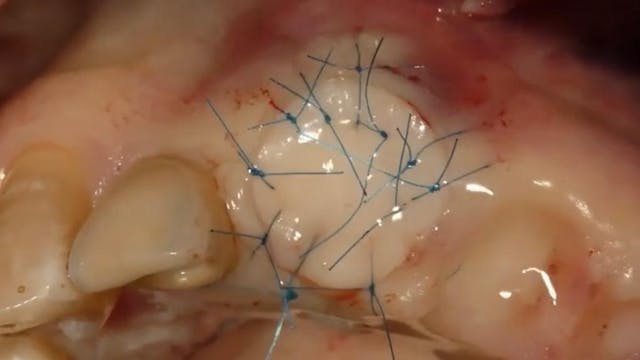CLINICAL VIDEO Soft tissue seal using...