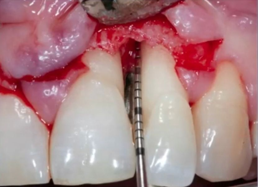 Clinical Concepts in Regenerative Periodontal Therapy