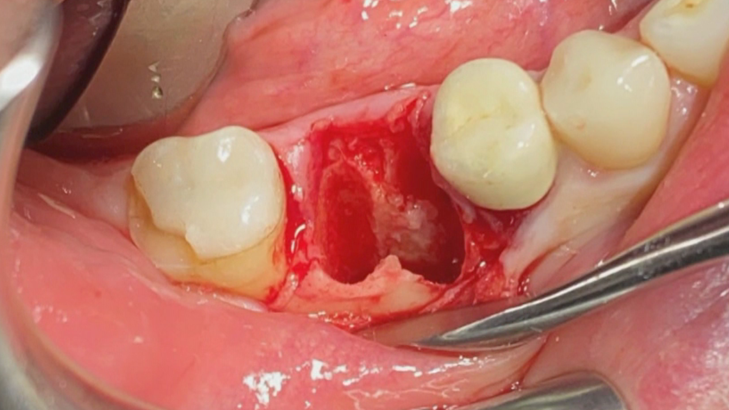 Extraction and Immediate Molar Implants - Improved Patient Solutions