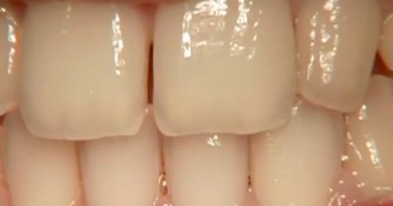 CLINICAL VIDEO Extraction of fractured maxillary premolar treated with implant p