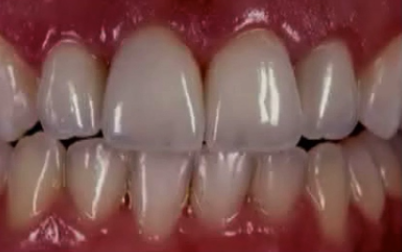 Perio-prosthetic Considerations Around Natural Teeth