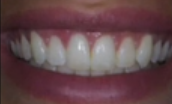 YSGG Laser Precision in Periodontal Plastic Surgery