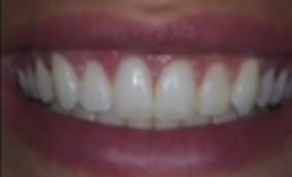 YSGG Laser Precision in Periodontal P...