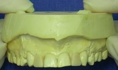 CLINICAL VIDEO Step-by-Step Radiographic and Surgical Guide Splint Manufacturing
