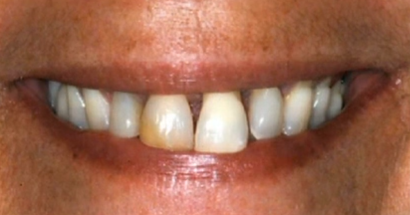 Minimally Invasive Soft Tissue Augmentation