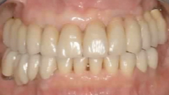 Immediate Loading: What Applications Can We Expect in the Future? (ITALIAN LANG