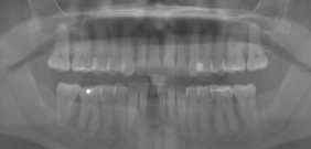 CLINICAL VIDEO NARRATED Staged Horizontal Ridge Augmentation using GBR in a Seve