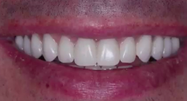 All-on-4 Protocol for Dentate Patients