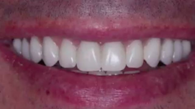 All-on-4 Protocol for Dentate Patients