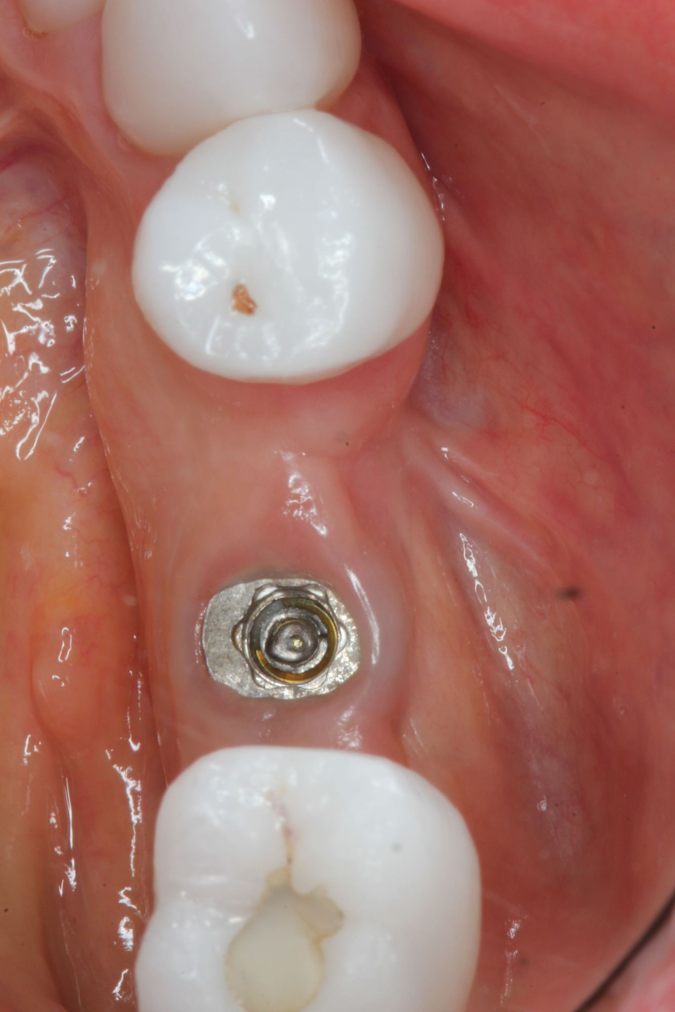 CLINICAL VIDEO Removing a Broken Abutment Screw
