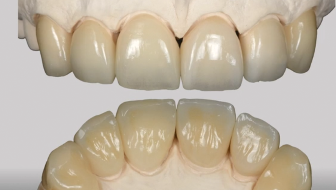 Tooth wear Interceptive & Conservative Treatment