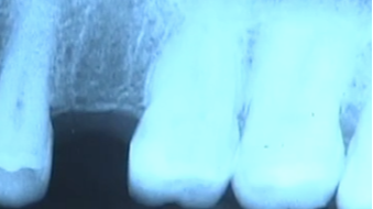 CLINICAL VIDEO Implant Placement for upper single premolar using NobelGuide mode