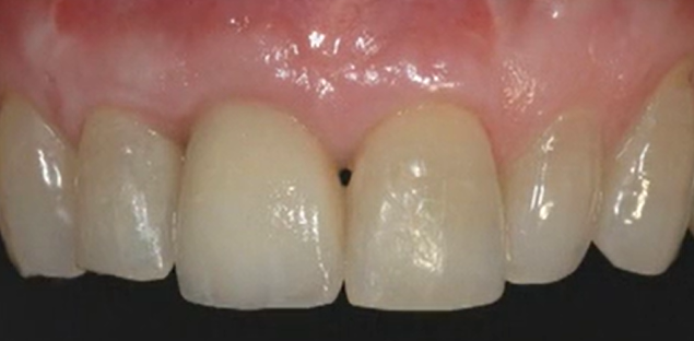 CLINICAL VIDEO Vertical Ridge Augmentation: Aesthetic Tissue Augmentation | Simi