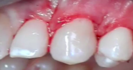 CLINICAL VIDEO Treatment of Multiple Gingival Recessions using a Tunneling appro
