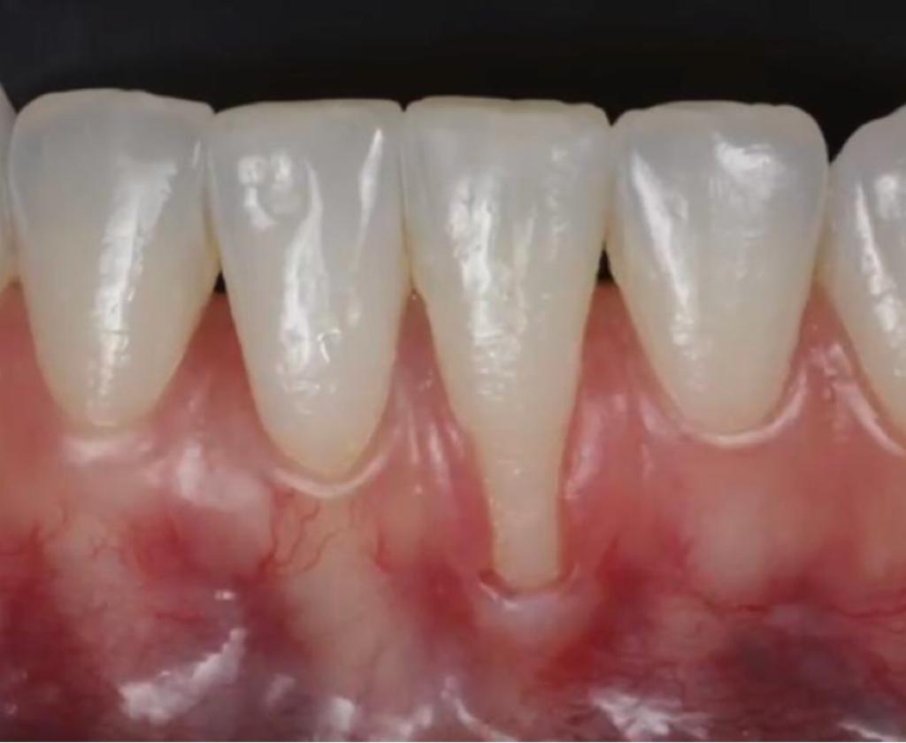 CLINICAL VIDEO Treatment of a Mandibular Anterior Tooth with Severe Gingival Rec
