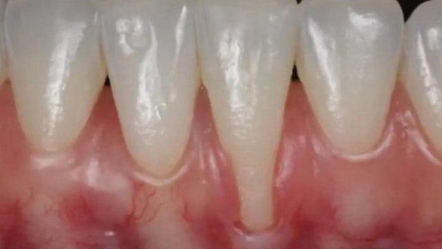 CLINICAL VIDEO Treatment of a Mandibular Anterior Tooth with Severe Gingival Rec