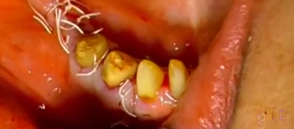 CLINICAL VIDEO Horizontal Augmentation Using Composite Bone Graft and Resorbable