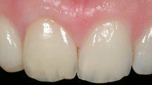 Restoration of 'Failing Teeth' with Implants in the Aesthetic Zone - Surgical a