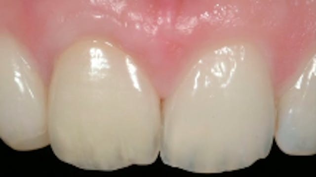 Restoration of 'Failing Teeth' with I...