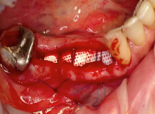 A GBR Experience Journey with d-PTFE Membranes | Dr Melle Vroom