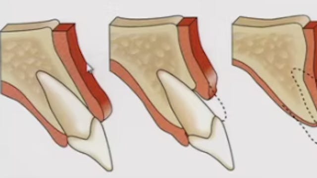 Esthetic Fine Tuning in Complex Impla...