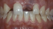 Contemporary Approaches to Soft Tissue Behavior Around Dental Implants