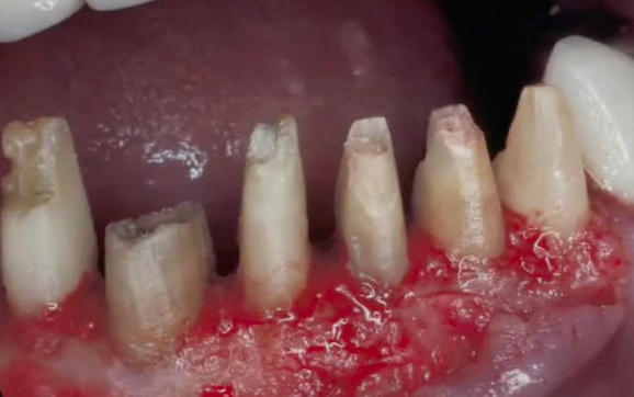 The Art and Science of Surgical Crown Lengthening | Dr Barry Wagenberg