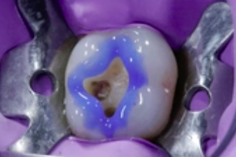 Adhesive & Esthetic Dentistry - Minimally Invasive Procedures (Part 3 of 4)