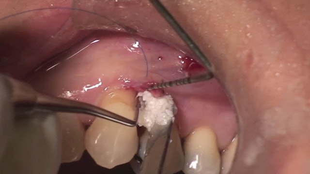CLINICAL VIDEO - Regenerative Periodontal Therapy of Intra-bony Defects using a 
