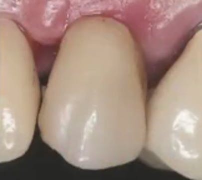 CLINICAL VIDEO Immediate Tooth Replac...