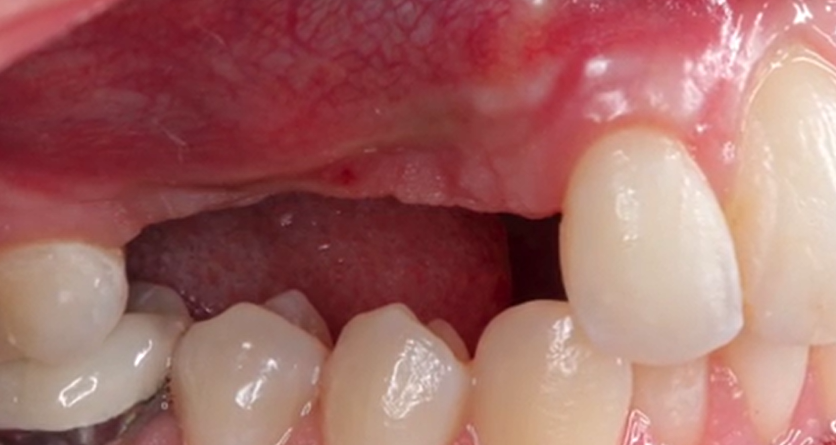 CLINICAL VIDEO Vertical and Horizontal GBR in the Anterior Maxilla | Jovanovic 