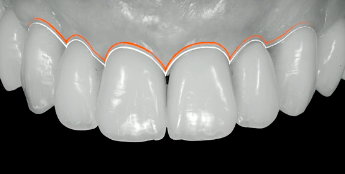 Hard & Soft Tissue Augmentation using GBR for Optimal Implant Esthetic & Long T
