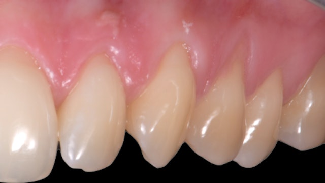 CLINICAL VIDEO Coronally Advanced Flap Technique for Gingival Recessions