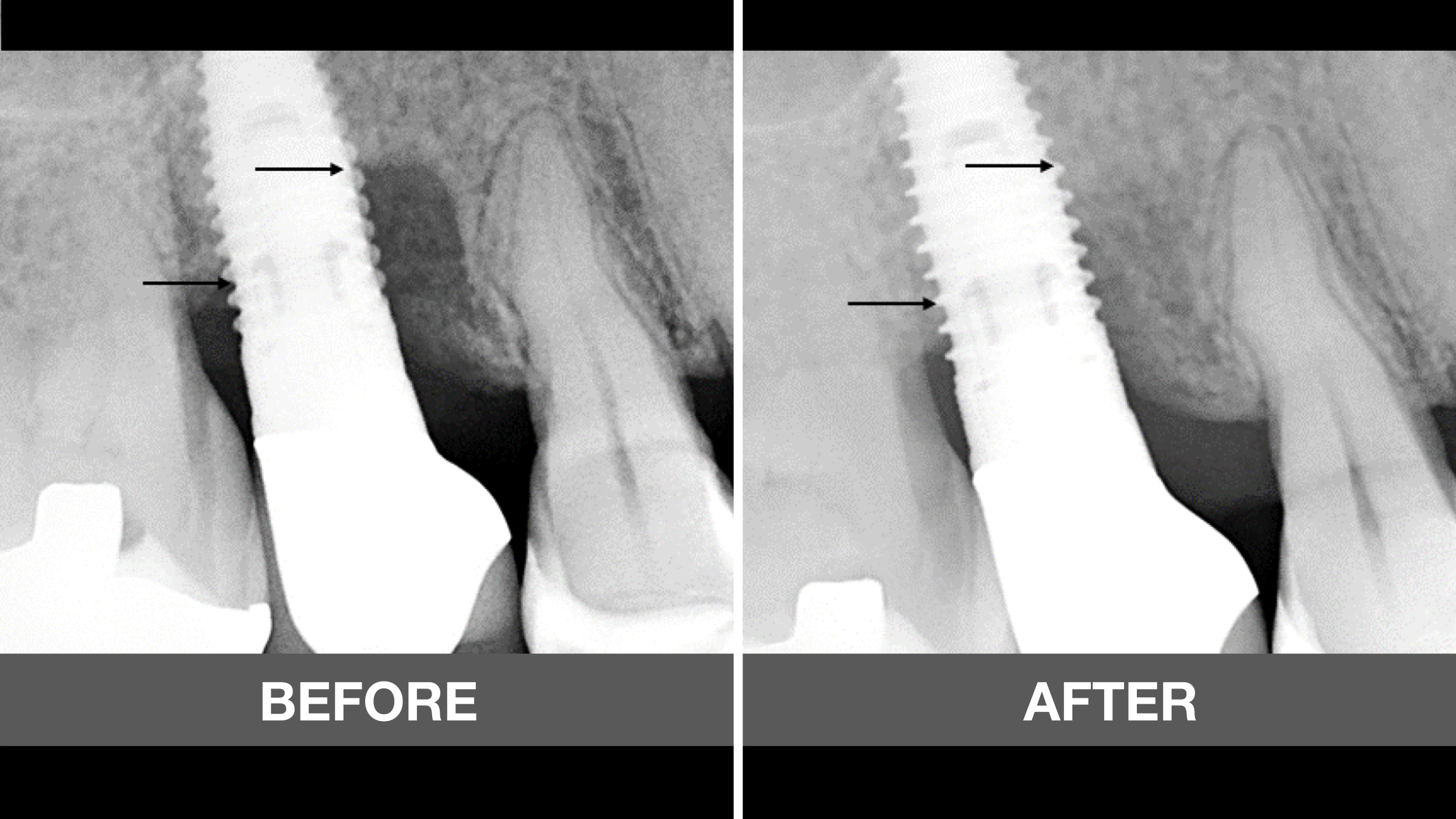 CLINICAL VIDEO Surgical Therapy of Periimplantitits with FGF-2
