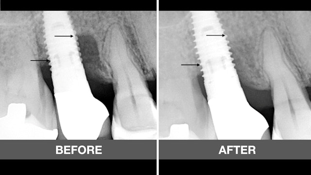 CLINICAL VIDEO Surgical Therapy of Periimplantitits with FGF-2