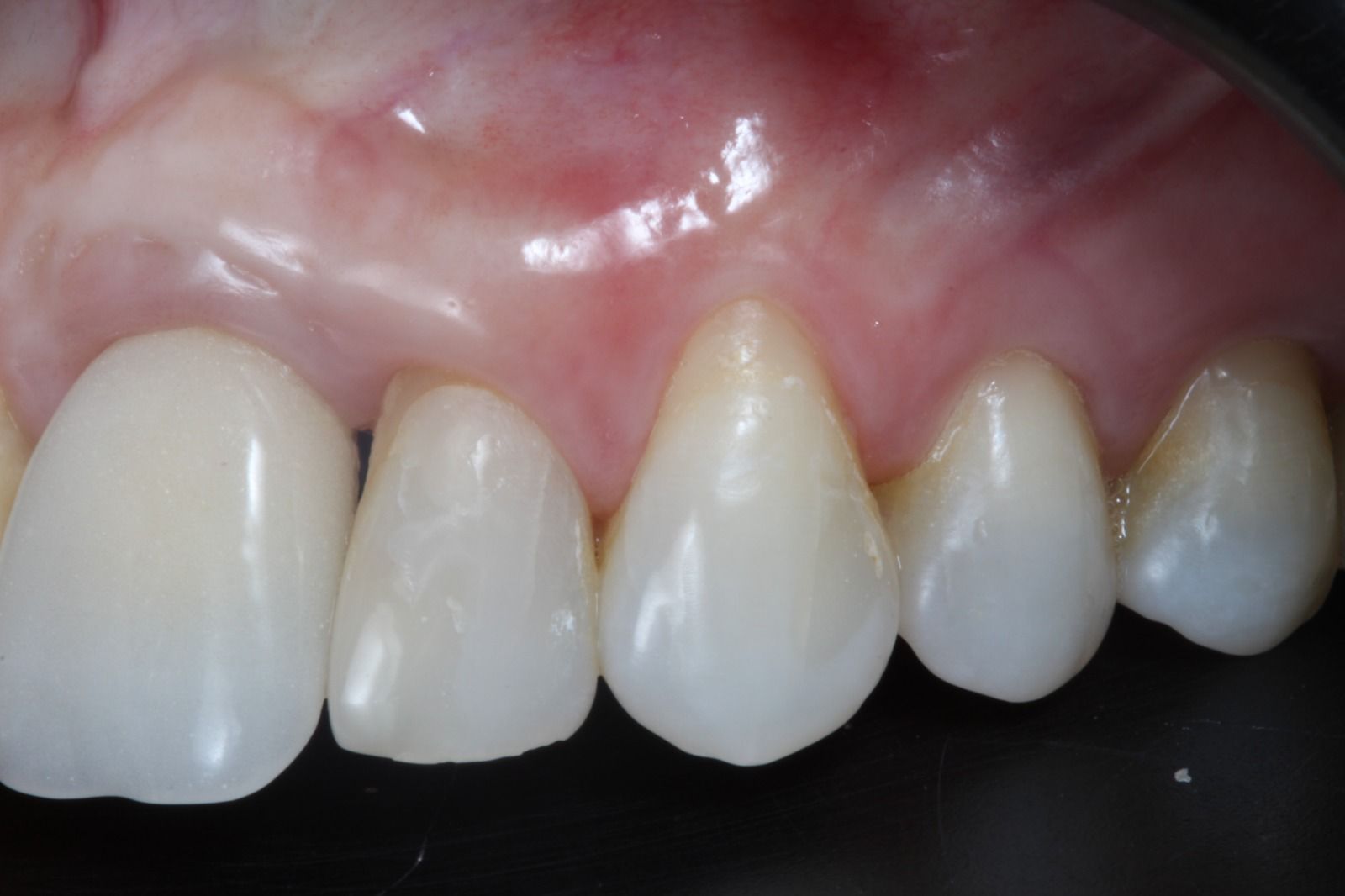 CLINICAL VIDEO Tunnel technique in the treatment of a single gingival recession 