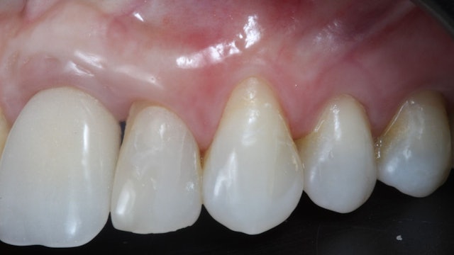 CLINICAL VIDEO Tunnel technique in the treatment of a single gingival recession 